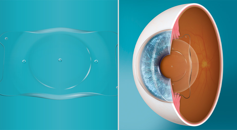 Read more about the article The Various Alternatives to Eye Surgery LASIK