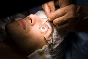 Read more about the article What Role Does Corneal Thickness Play in Eye Surgery LASIK?