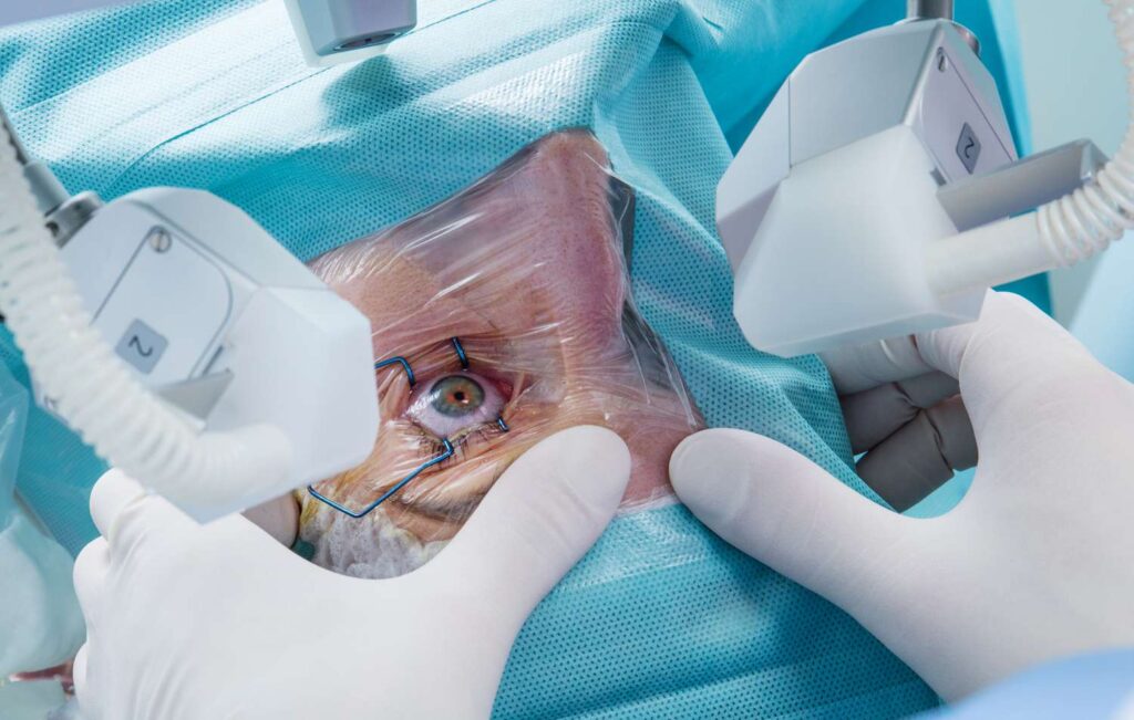 LASIK Eye Surgery procedure